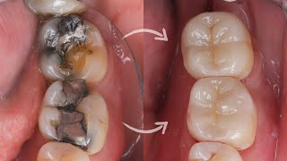 Ceramic ONLAY amp OVERLAY cementation StepbyStep [upl. by Inaja]