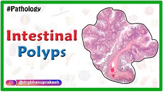 Intestinal polyps  Pathology lectures for fmge and neet pg [upl. by Lust]