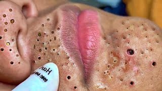 Big Cystic Acne Blackheads Extraction Blackheads amp Milia Whiteheads Removal Pimple Popping  5666 [upl. by Abramo]