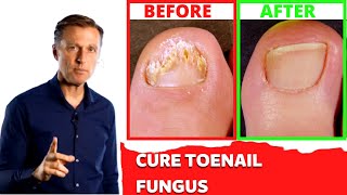 Treating toenail fungus Home Remedy Natural  Dr Berg [upl. by Isoj]