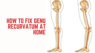 How to fix Genu RecurvatumHyperextended knee at home [upl. by Enatan]