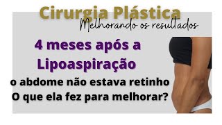 4 meses após a Lipoaspiração e o abdome não estava retinhoveja o que ela fez para melhorar [upl. by Doria]