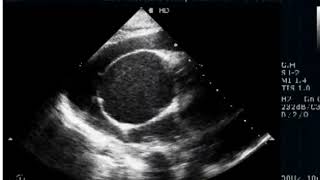 Severe Pulmonic Stenosis  RV non Compaction [upl. by Penn]