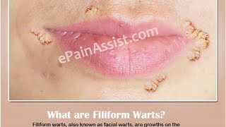 Filiform Warts Causes Symptoms and Treatment [upl. by Iahcedrom]