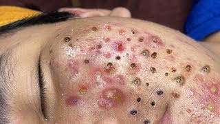 Big Cystic Acne Blackheads Extraction Blackheads amp Milia Whiteheads Removal Pimple Popping  3724 [upl. by Raynata]