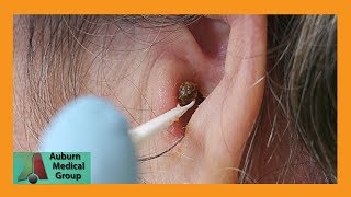 Chunky Earwax Removal  Auburn Medical Group [upl. by Vigen]