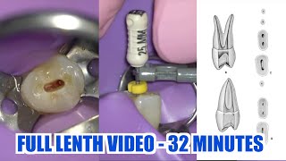 Live Root Canal Procedure under Microscope on Premolar w Endodontist [upl. by Landon]