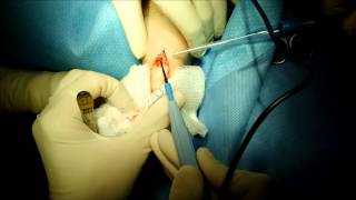 Large Wart on Foot surgical excision [upl. by Ahtamas]