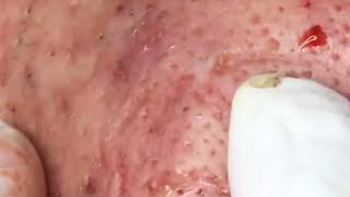 how to reduce blackheads from nose  get rid of comedones on face permanently [upl. by Latrell]