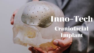 Craniofacial Implant [upl. by Inafets]