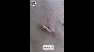 RockLike Blackhead from Clients Back [upl. by Darraj]