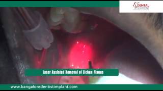 Lichen Planus Removal In Bangalore  Mouth Infection Treatment In India [upl. by Akcinehs]