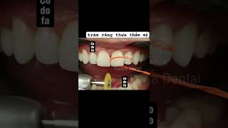 composite veneers nhakhoacodofa dentist dental shorts shortvideo [upl. by Otsuj]