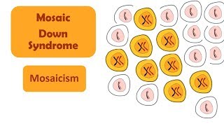 Mosaic Down Syndrome  Mosaicism  A type of Down Syndrome [upl. by Yzmar452]