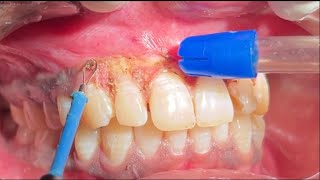 Correction of Black Gums  Depigmentation  LASER vs ELECTROSURGERY  Demo  PERIO SUBHARTI 🇮🇳 [upl. by Ilana]