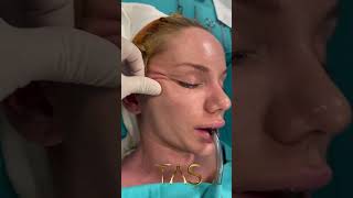 Scarless facelift amp neck lift by the one and only Dr Suleyman Tas [upl. by Romilly]