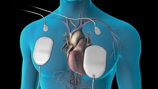 Cardioversion for Atrial Fibrillation [upl. by Mairym362]