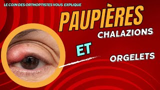 Comment soigner un chalazion  un Orgelet  Tu risques d’être surpris Maladie des paupières [upl. by Ecnarrat]