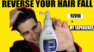 MINOXIDIL 10 MINTOP REVIEW  HOW TO USE SIDE EFFECTS amp MY EXPERIENCE  minoxidil results [upl. by Ennylyak]