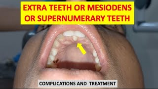 SUPERNUMERARY TEETH MESIODENS EXTRA TEETH COMPLICATIONS AND TREATMENT dentalcafe4331 [upl. by Turley144]