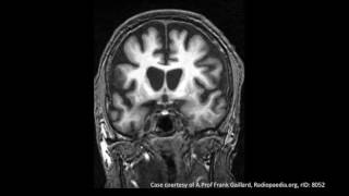 Huntingtons Disease [upl. by Whitford]