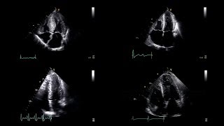 2D Echocardiographic Morphology of Left Ventricular Strain Patterns [upl. by Leena]