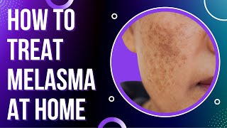 How to treat MELASMA at Home  Treat DARK SPOTS amp PATCHES on the skin [upl. by Leitao]