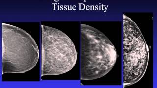 Introduction to Mammography [upl. by Aurelea]