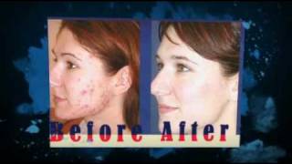 Tetracycline Acne Treatment [upl. by Isac]