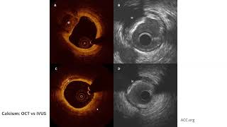 OCT Optical Coherence Tomography Elias Hanna Univ of Iowa [upl. by Robby]