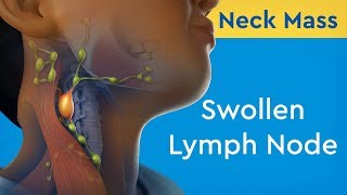 Neck Mass Swollen Lymph Node [upl. by Gillan]