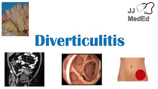 Diverticulitis Risk Factors ex Low Fiber Diets Symptoms Diagnosis Treatment and Complications [upl. by Eimmit951]