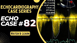 ECHO CASE 82  Echocardiography Spot Diagnosis Series  Echocardiogram Interpretation made easy [upl. by Bender]