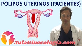 PÓLIPOS UTERINOS PACIENTES Síntomas diagnóstico y tratamiento  Ginecología y Obstetricia [upl. by Demodena]