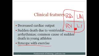 8 6 Cardiomyopathy 8 7 Cardiac Tumors [upl. by Anelys]