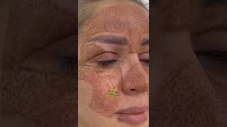 Fibroblastplasma fibroblastskintightening ترند fibroblasting skincare [upl. by Fronnia]