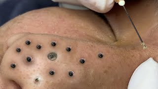 Big Cystic Acne Blackheads Extraction Blackheads amp Milia Whiteheads Removal Pimple Popping  1342 [upl. by Sihun205]