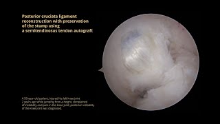 Posterior cruciate ligament reconstruction with preservation of the stump using a semitendinosus ten [upl. by Kall]