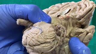 Dissection  Sulci amp Gyri on inferior surface of brain [upl. by Nitas733]