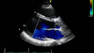 PARASTERNAL VIEW LAX  COLOR  NORMAL STUDY [upl. by Kcirtemed]