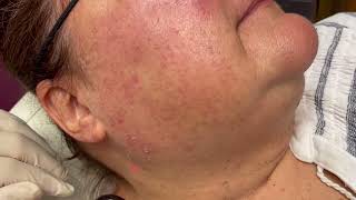 Removing Solar Lentignos amp Seborrheic Keratosis SKs with Lasers [upl. by Burner]