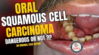 ORAL SQUAMOUS CELL CARCINOMA  HOW DANGEROUS OR LEATHAL IS IT  AN ORIGINAL CASE REPORT PART 1 [upl. by Alick]