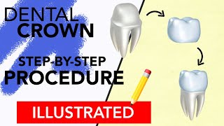 Dental Crown StepByStep Procedure Illustrated [upl. by Pros]