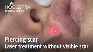 Piercing scar  Laser treatment without visible scar  24094 [upl. by Boggers]