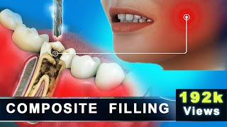 Composite Filling  Molar Cavity Filling with Composite  Advance 3D Dental Animation [upl. by Vanna]