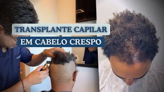 Descubra a Vantagem do Cabelo Crespo no Transplante Capilar [upl. by Karl]