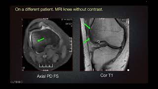 Sports Medicine Case 26 19yearold Soccer Player with Quadriceps Weakness [upl. by Bueschel]