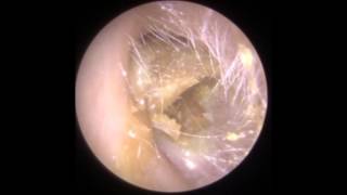 Ear Wax Removal Endoscopic  Clearwax  Ear Wax Removal Specialists [upl. by Yralam]