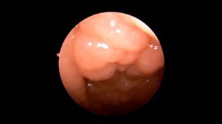 Endoscopic Adenoidectomy with microdebridator [upl. by Haya569]