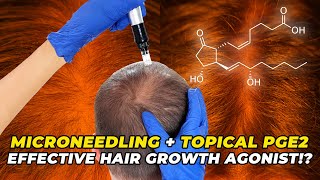 Microneedling  Topical PGE2 – The Most Effective Hair Growth Agonist [upl. by Nickie]